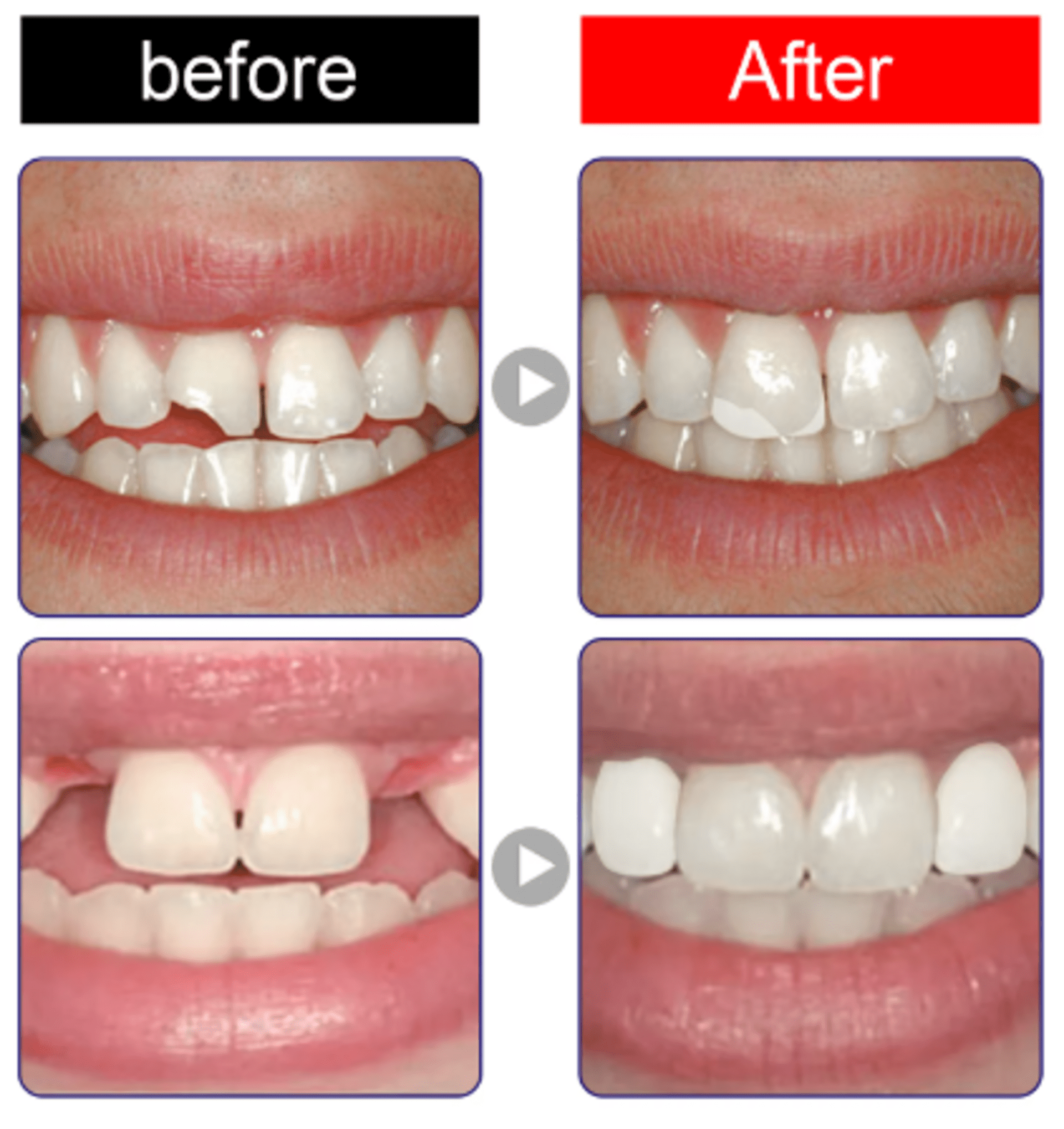 Pegamento de reparación de dientes de resina - 2